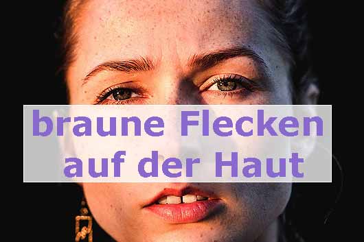 Braune Flecken Auf Der Haut Gute Gesundheit ᐅᐅ Ratgeber